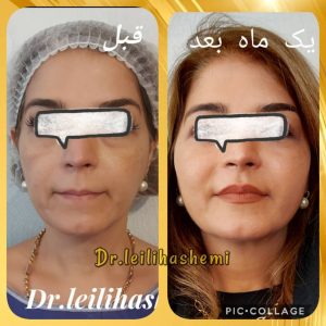 تزریق چربی با روش کلاسیک یا نانوفت