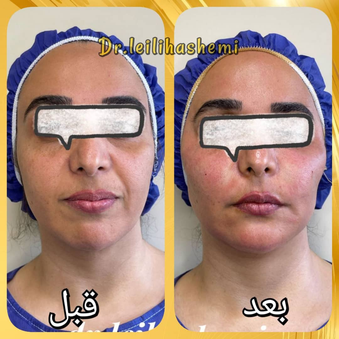 ماندگاری تزریق چربی چقدر است؟