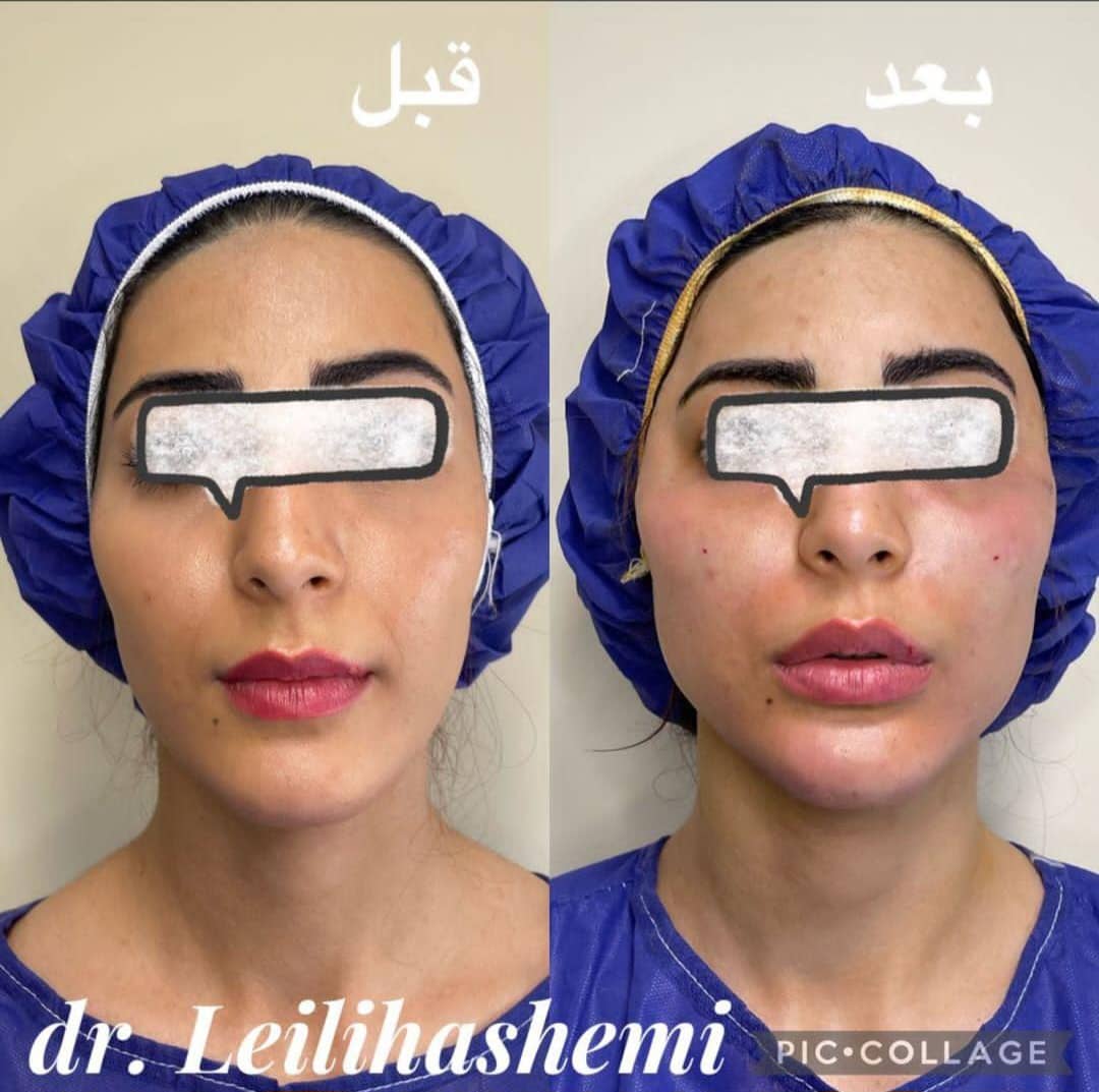 تزریق چربی صورت