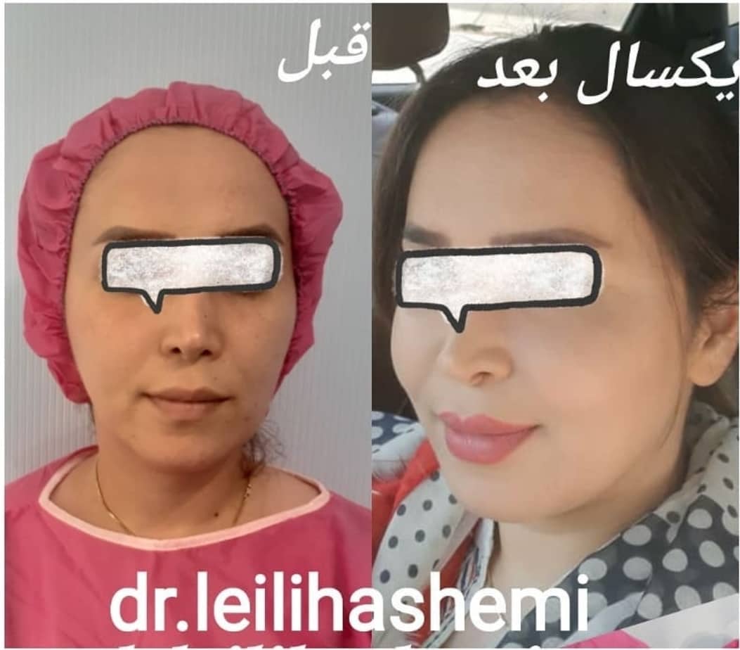 ماندگاری در نواحی مختلف صورت و لب