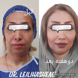 ماندگاری در نواحی مختلف صورت