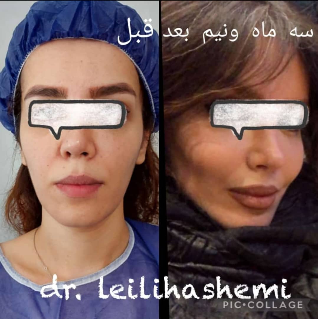 ماندگاری در نواحی مختلف صورت و گونه