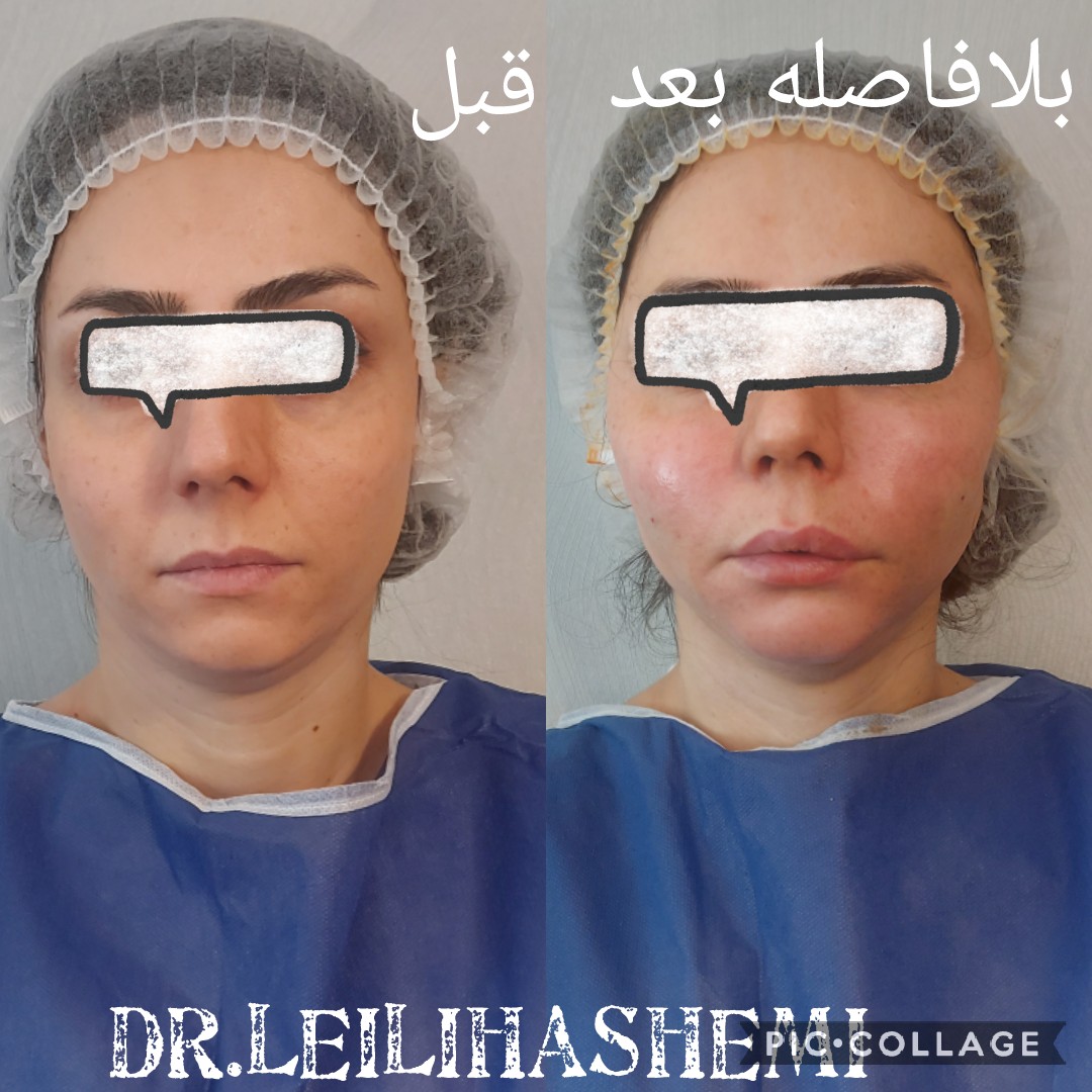 تزریق چربی به صورت در تهران