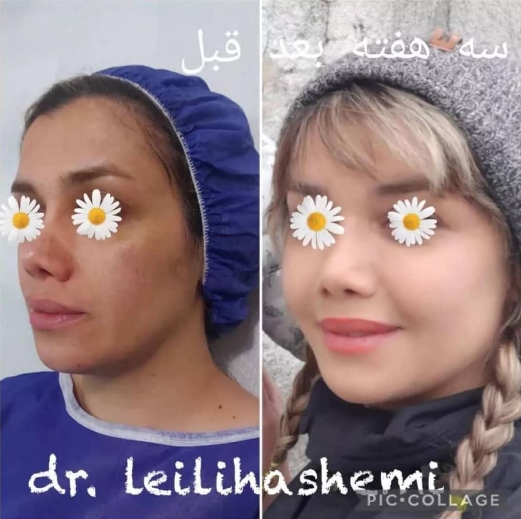 تزریق چربی با روش کلاسیک یا نانوفت