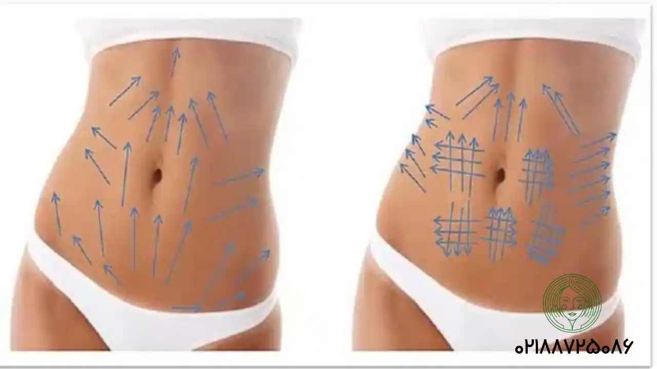 آیا کاهش وزن با امبدینگ ماندگار است؟