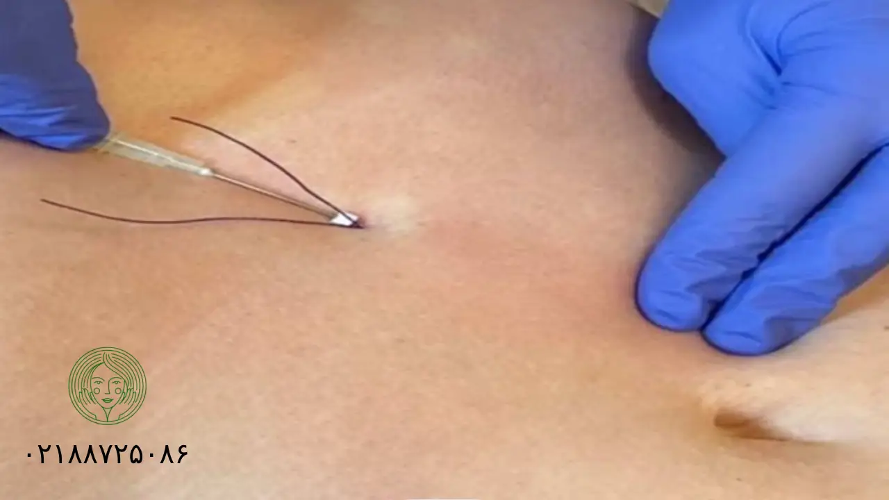 اهمیت رژیم غذایی بعد از امبدینگ یا کاشت نخ