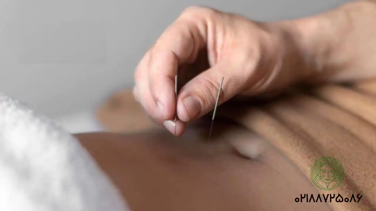 امبدینگ یا کاشت نخ چیست