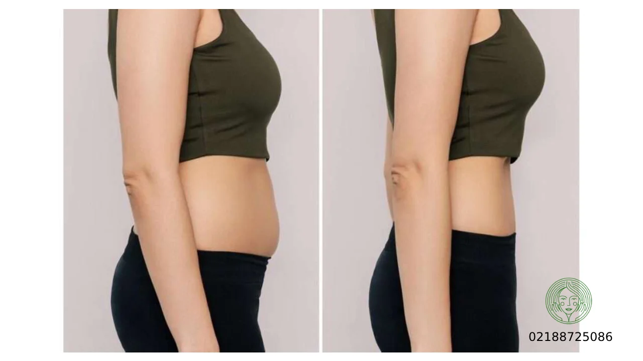 امبدینگ شکم و پهلو و قیمت آن