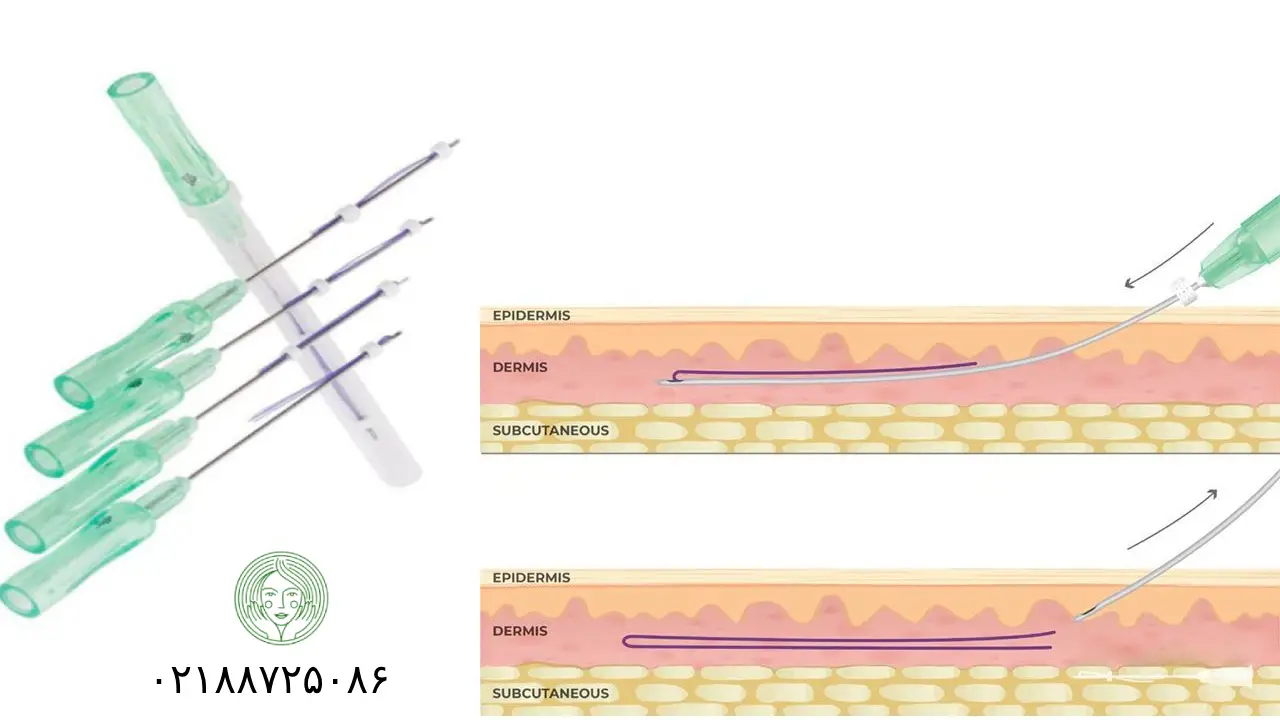 امبدینگ یا کاشت نخ چیست؟