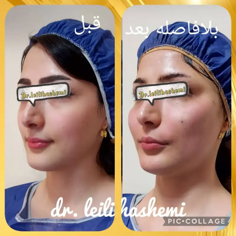 آیا مراقبت‌های خاصی پس از تزریق چربی به صورت لاغر و استخوانی لازم است؟