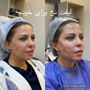 لیفت نخ در تهران