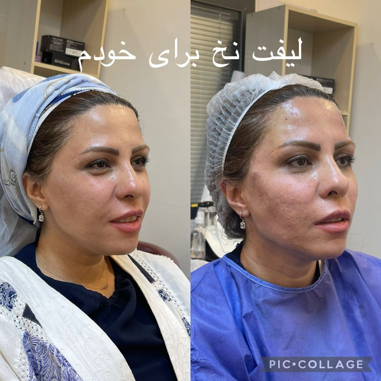 لیفت نخ در تهران