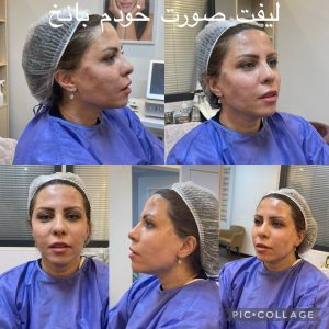 لیفت نخ در کلینیک دکترهاشمی