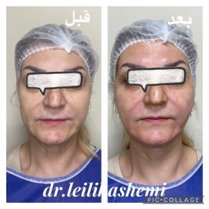 نمونه کار لیفت نخ دکتر هاشمی