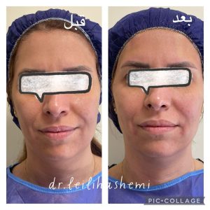 لیفت نخ در کلینیک دکترهاشمی