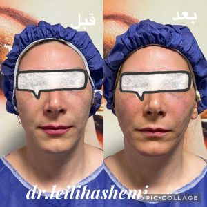 لیفت صورت با نخ در تهران در کلینیک دکترهاشمی