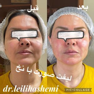 لیفت صورت با نخ در تهران در کلینیک دکترهاشمی