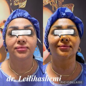 لیفت صورت با نخ