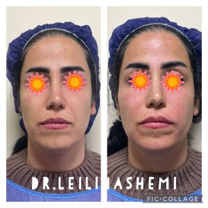 لیفت صورت با نخ در تهران