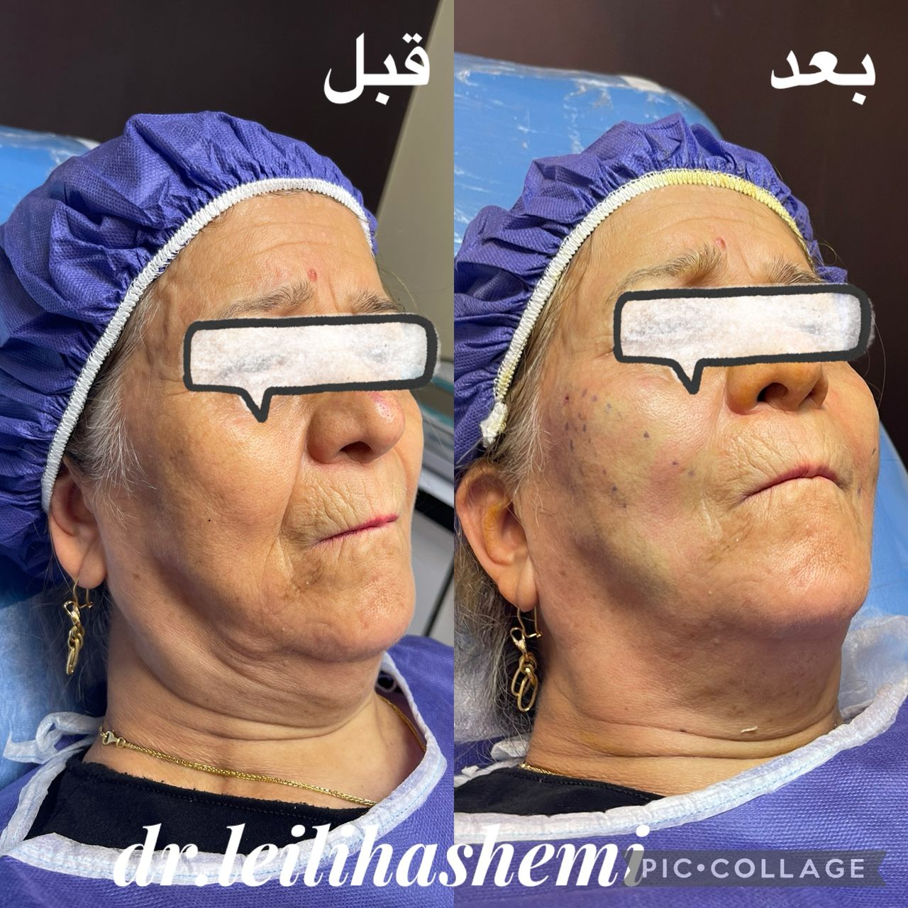 نمونه کار لیفت نخ دکتر هاشمی