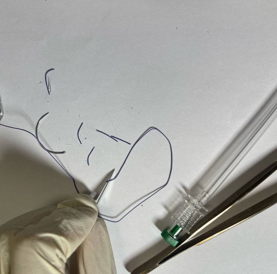 تاثیر امبدینگ یا کاشت نخ در لاغری و کاهش وزن: