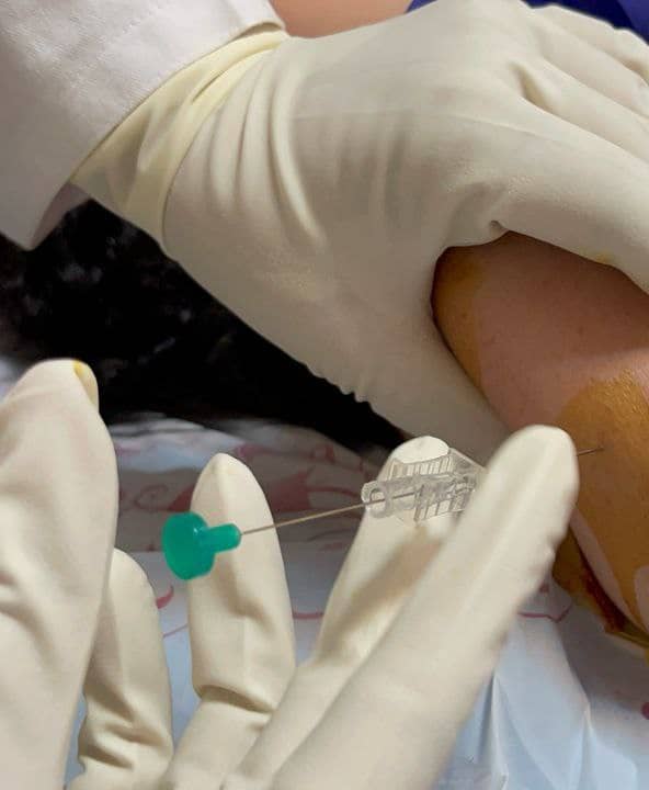 مزایای کاشت نخ امبدینگ