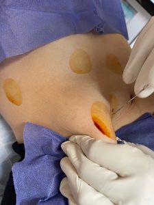 امبدینگ پهلو