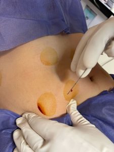 امبدینگ و لاغری پهلو