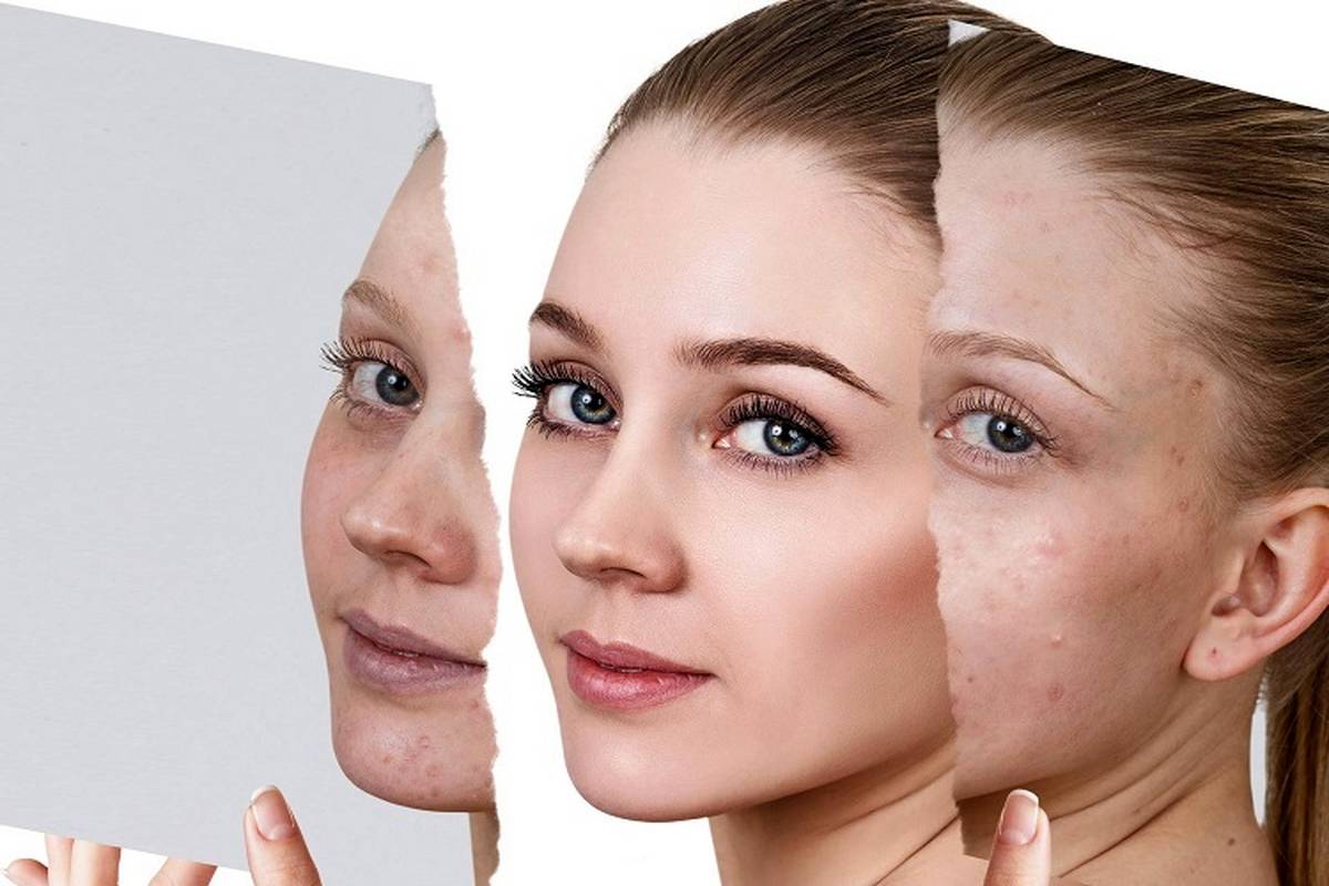 مقایسه تزریق چربی برای از بین بردن جای جوش و اسکار با سایر روش ها