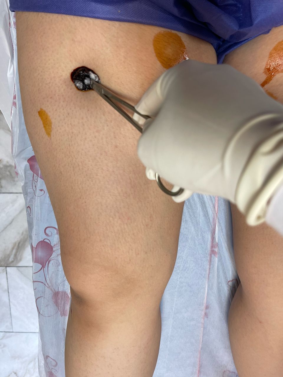 مراقبت ‌های بعد از امبدینگ ران و ساق پا