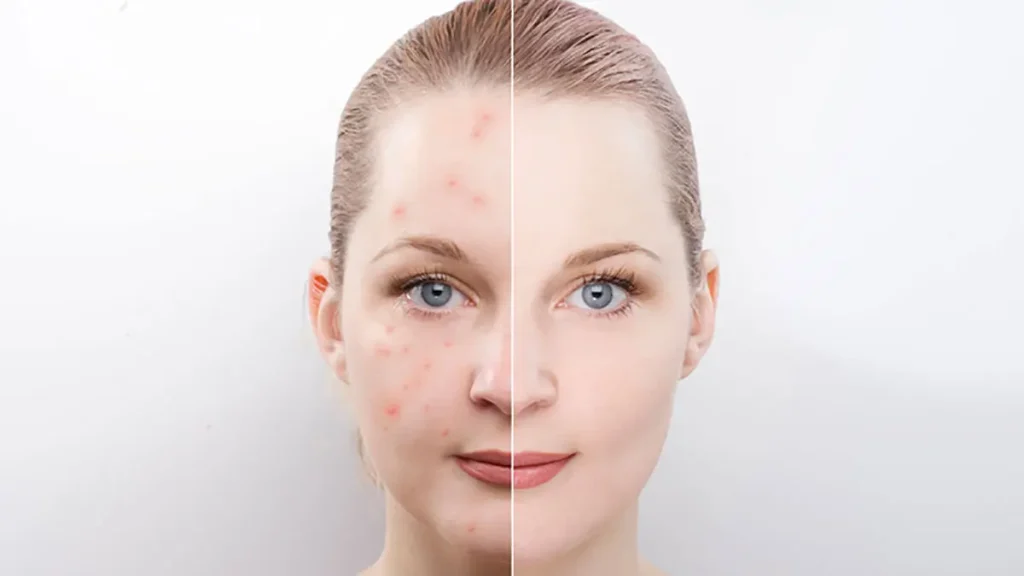 تزریق چربی برای جای جوش و اسکار