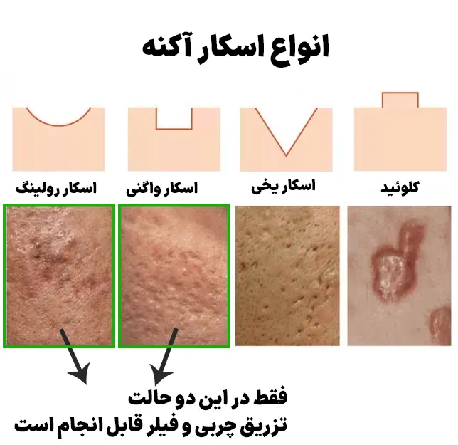 تزریق چربی برای جای جوش و اسکار به روش نانوفت