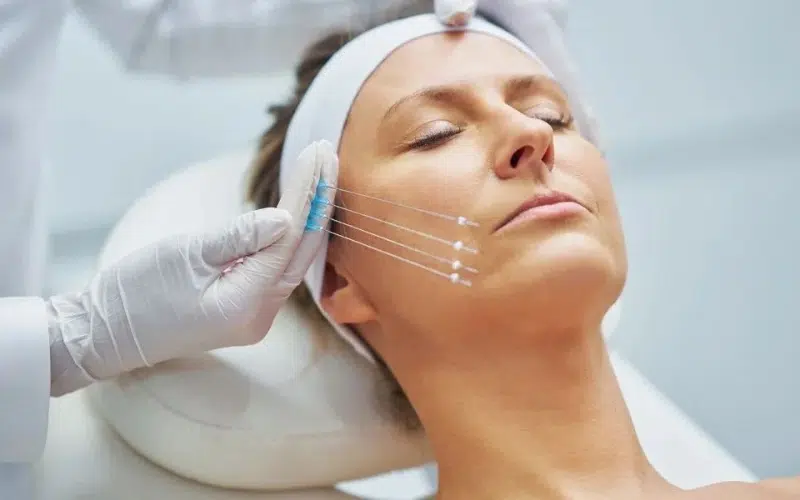 لیفت صورت با نخ چیست و چگونه انجام می شود؟