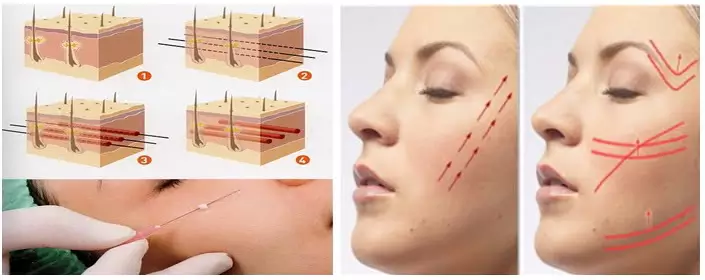 لیفت صورت و بدن با نخ