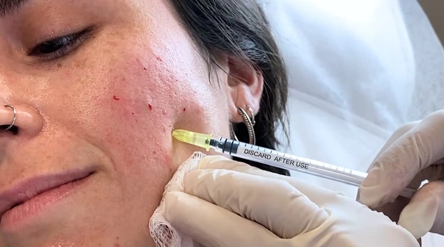 مزوتراپی صورت برای چه سنی مناسب است؟