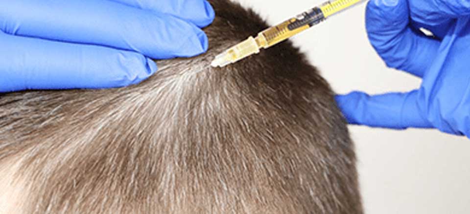 آیا مزوتراپی بعد از کاشت مو واجب است؟ 