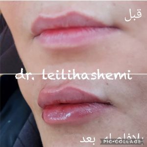 تزریق ژل لب نچرال