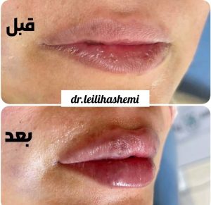 تزریق فیلر لب
