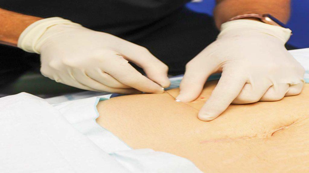 کیس های نامناسب برای استفاده از روش امبدینگ در درمان اختلالات گوارشی