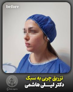 قبل تزریق چربی 