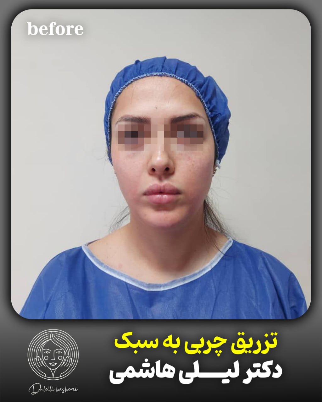 قبل از تزریق چربی صورت