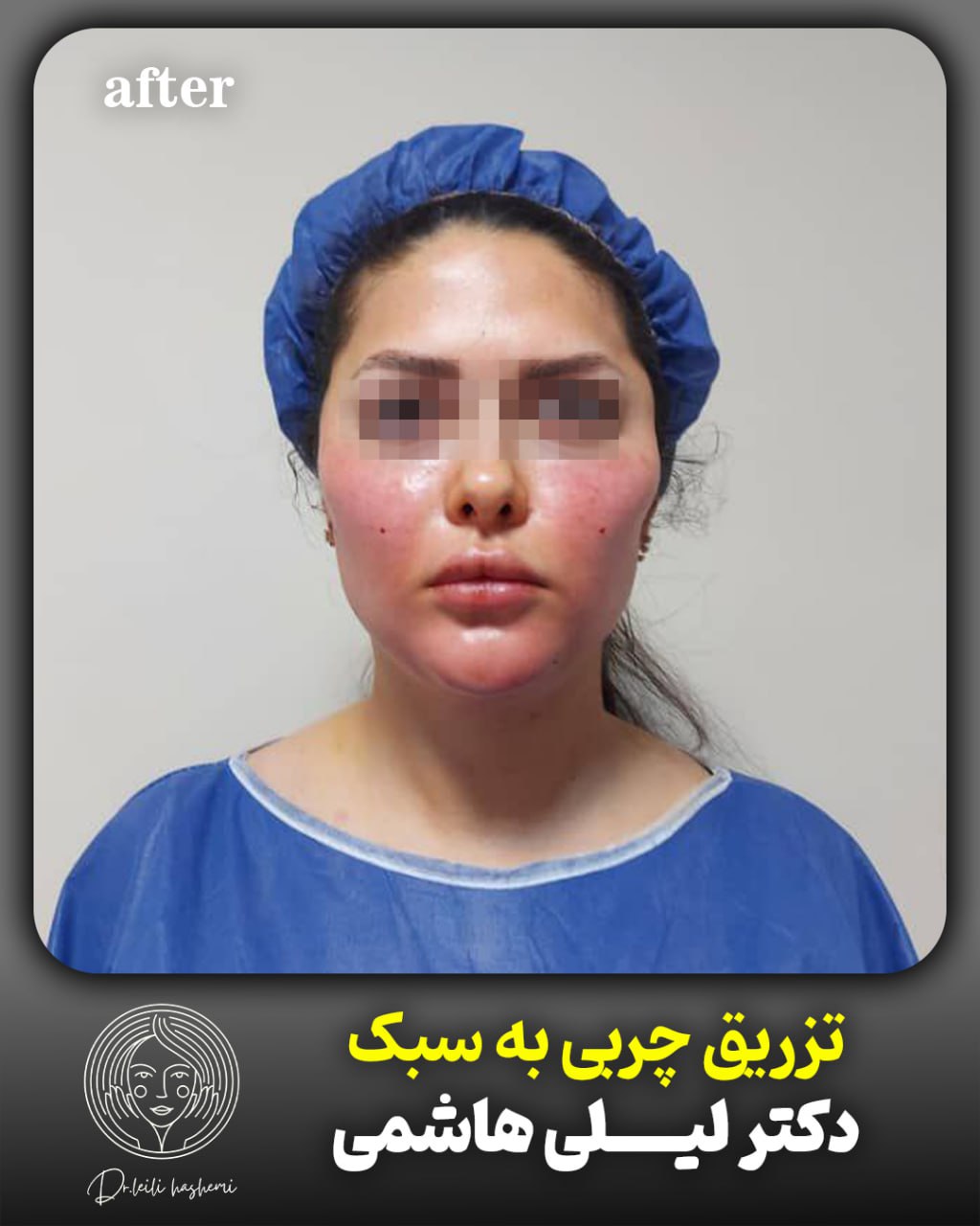 بعد از تزریق چربی صورت