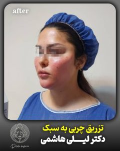 بعد از تزریق چربی 