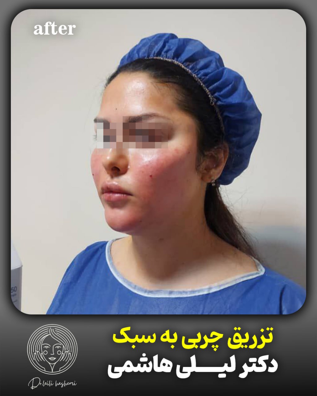 بعد از تزریق چربی