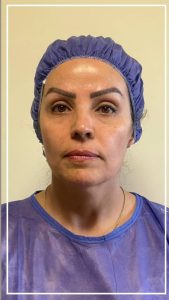 تزریق چربی صورت