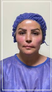 قبل و بعد از تزریق چربی صورت