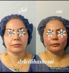 قبل و بعد از تزریق چربی صورت