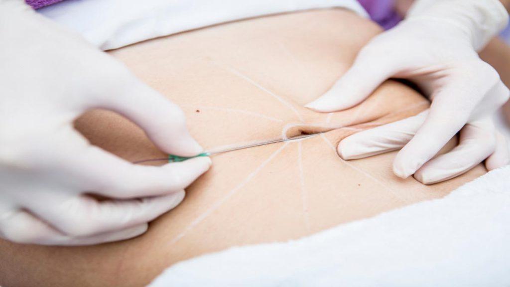 نحوه عملکرد امبدینگ در لاغری و کاهش وزن