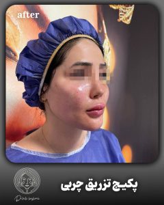 بعد از تزریق چربی