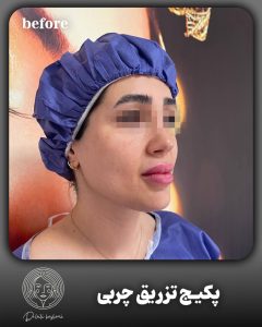 بعد از تزریق چربی